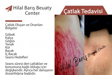 Adana Çatlak Tedavisi | 0 534 960 86 76